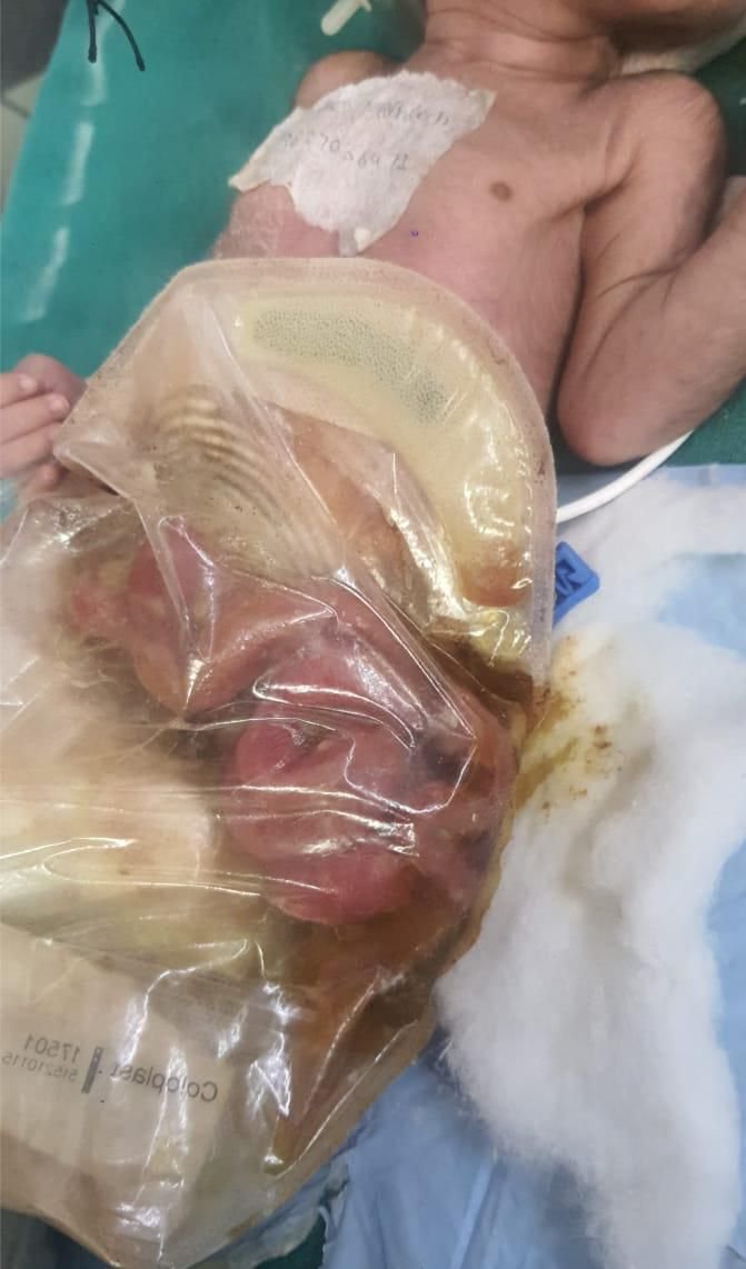 Doctors at SN Medical College performing gastroschisis surgery on a 1.4 kg newborn, saving the baby’s life